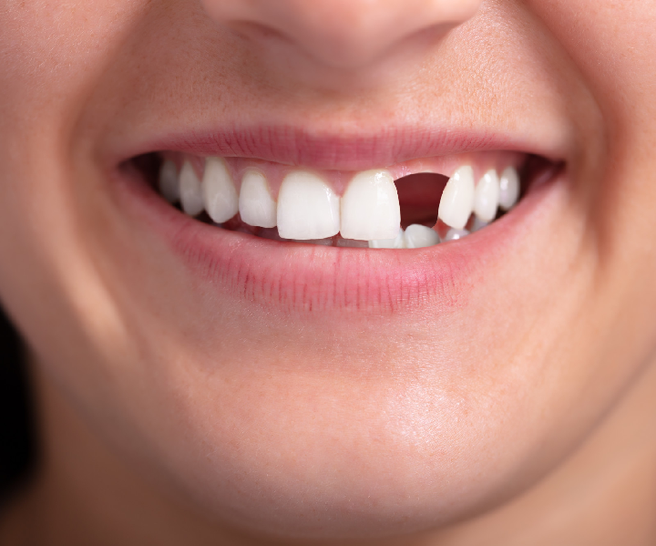 Top Signs That You Need Tooth Replacement