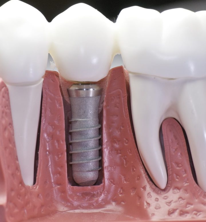 Replacing Missing Teeth: Reasons Dental Implants May be Right for You