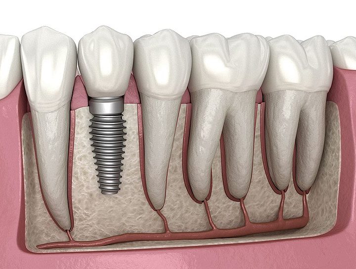 Six Reasons Why Dental Implants Are the Best Option